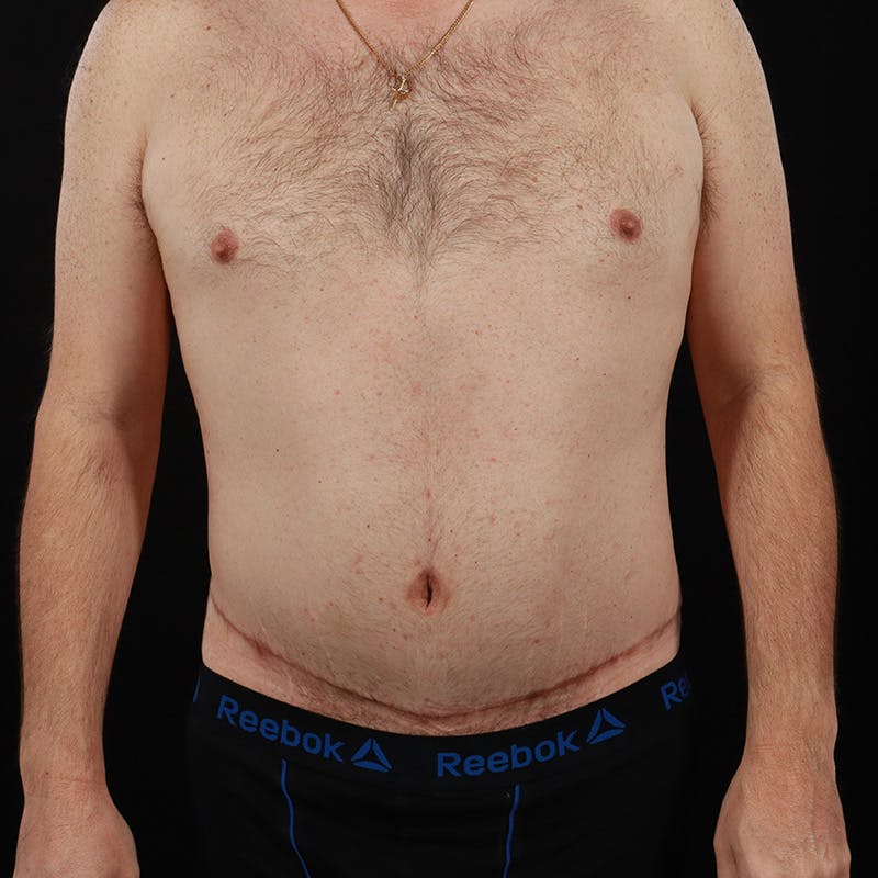 Abdominoplasty (Tummy Tuck) Before & After Gallery - Patient 179898045 - Image 2