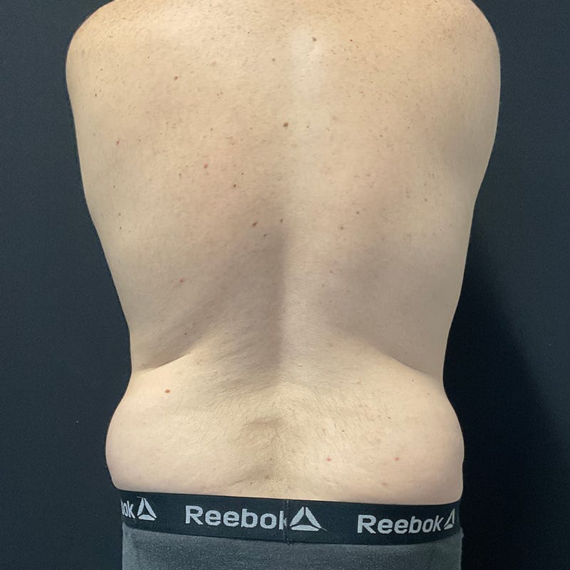 Body Contouring Before & After Gallery - Patient 179898567 - Image 7