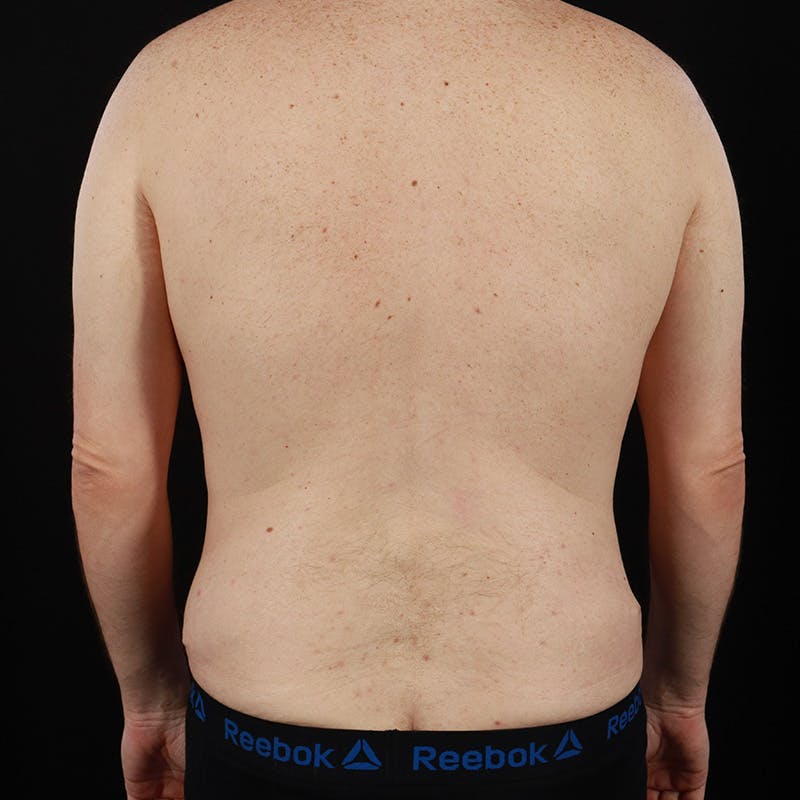 Body Contouring Before & After Gallery - Patient 179898567 - Image 8
