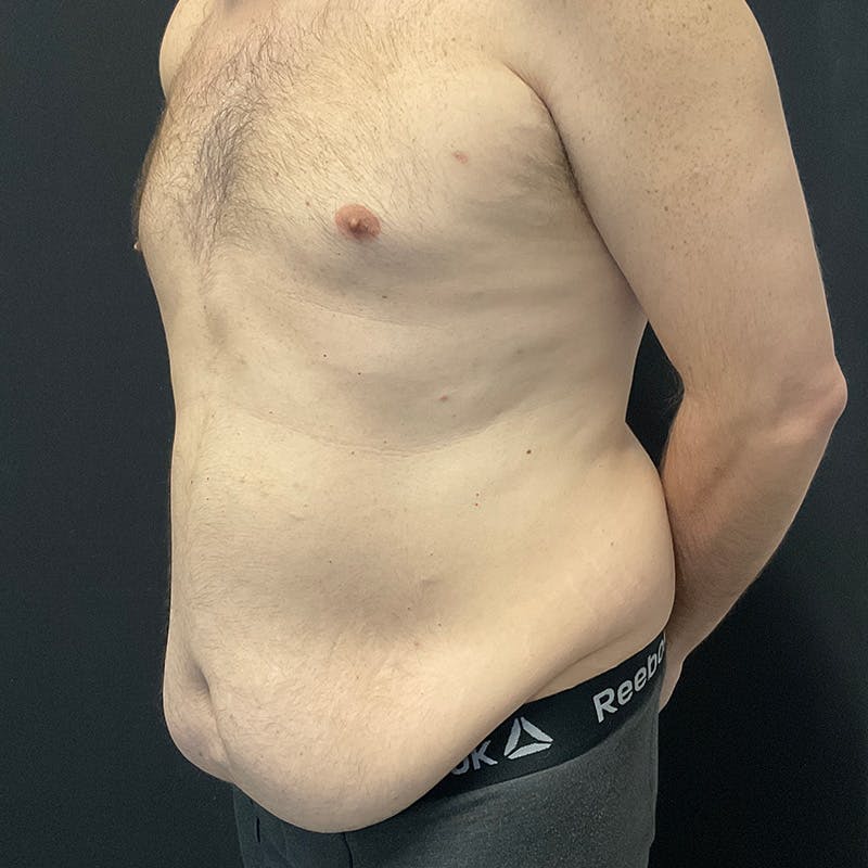 Abdominoplasty (Tummy Tuck) Before & After Gallery - Patient 179898045 - Image 9