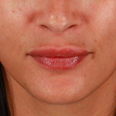 Dermal Fillers Before & After Gallery - Patient 179898292 - Image 1