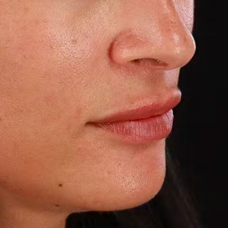 Dermal Fillers Before & After Gallery - Patient 179898292 - Image 3