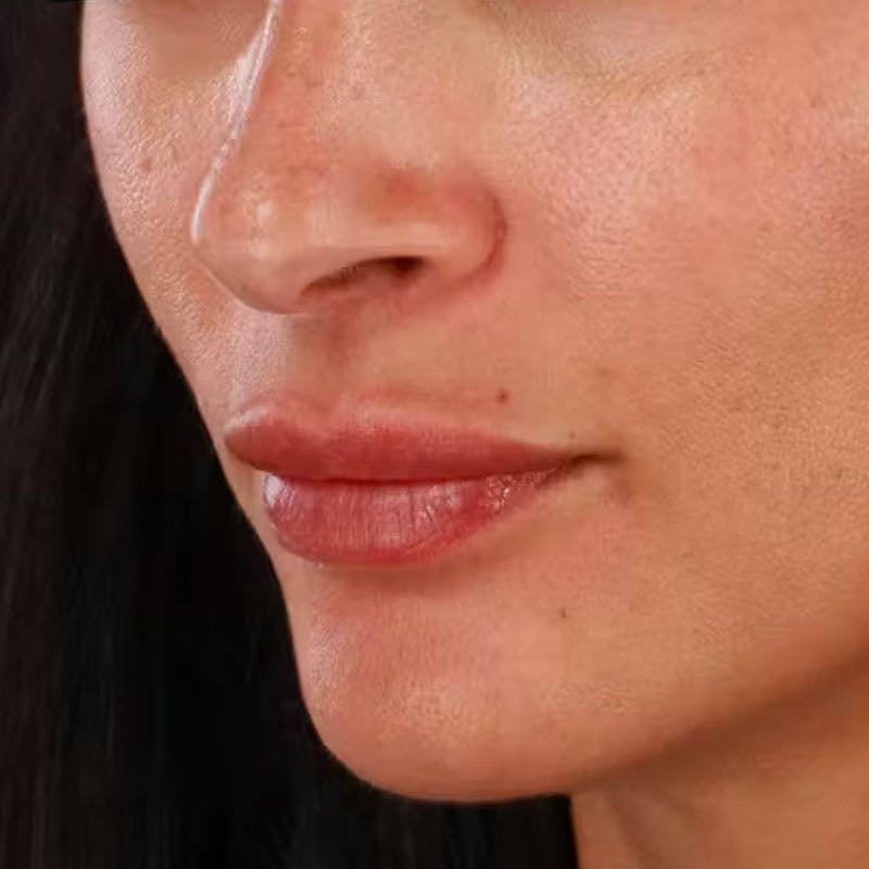 Dermal Fillers Before & After Gallery - Patient 179898292 - Image 5