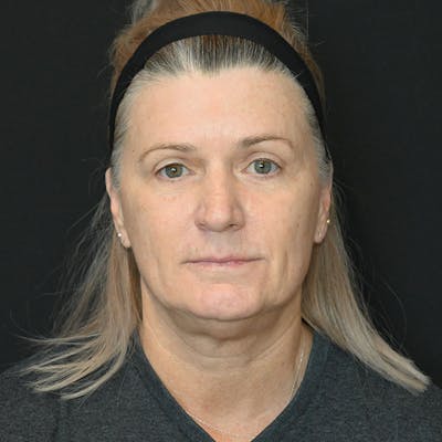 Facelift Before & After Gallery - Patient 188513129 - Image 1