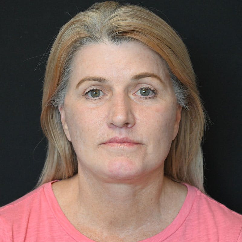 Facelift Before & After Gallery - Patient 188513129 - Image 2