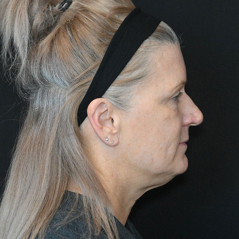 Neck Lift Before & After Gallery - Patient 188513130 - Image 9