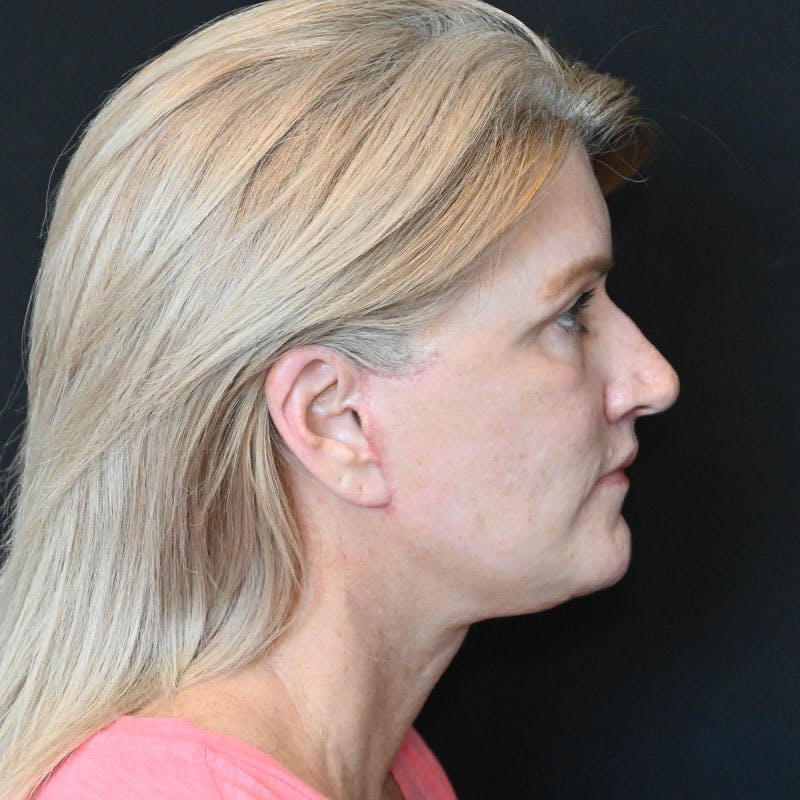 Neck Lift Before & After Gallery - Patient 188513130 - Image 10