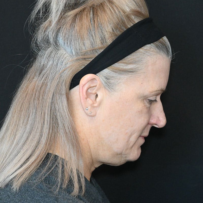Facelift Before & After Gallery - Patient 188513129 - Image 5