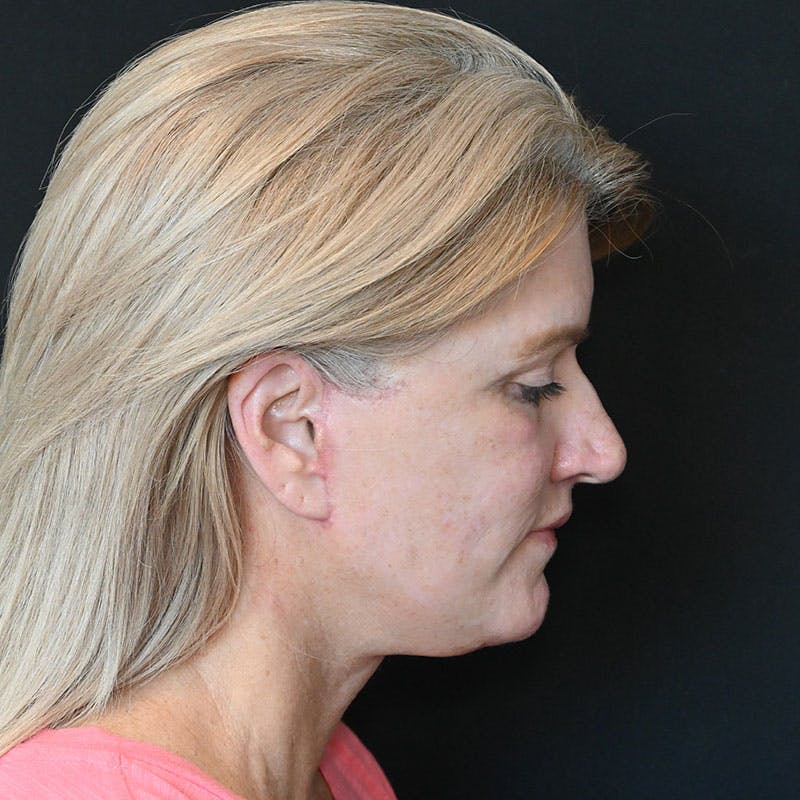 Neck Lift Before & After Gallery - Patient 188513130 - Image 8