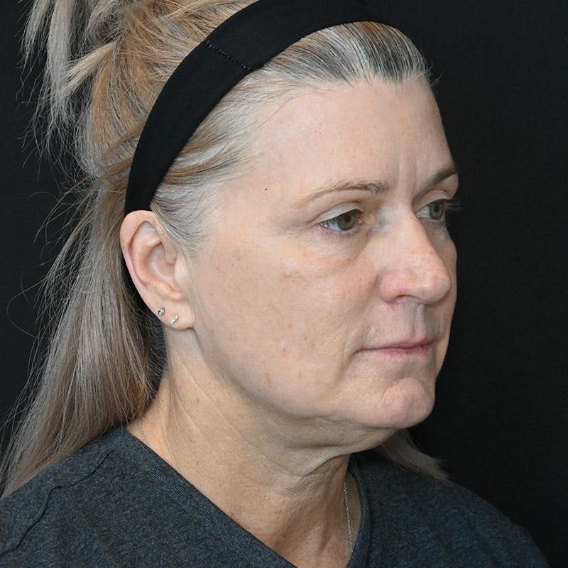 Neck Lift Before & After Gallery - Patient 188513130 - Image 5