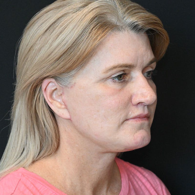 Facelift Before & After Gallery - Patient 188513129 - Image 8