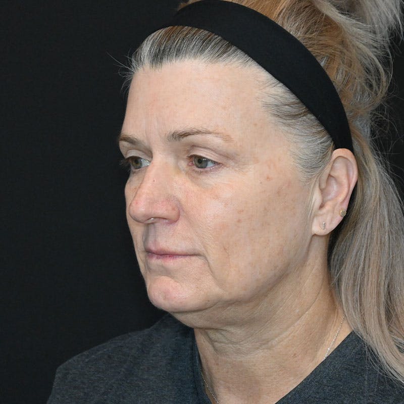 Facelift Before & After Gallery - Patient 188513129 - Image 9