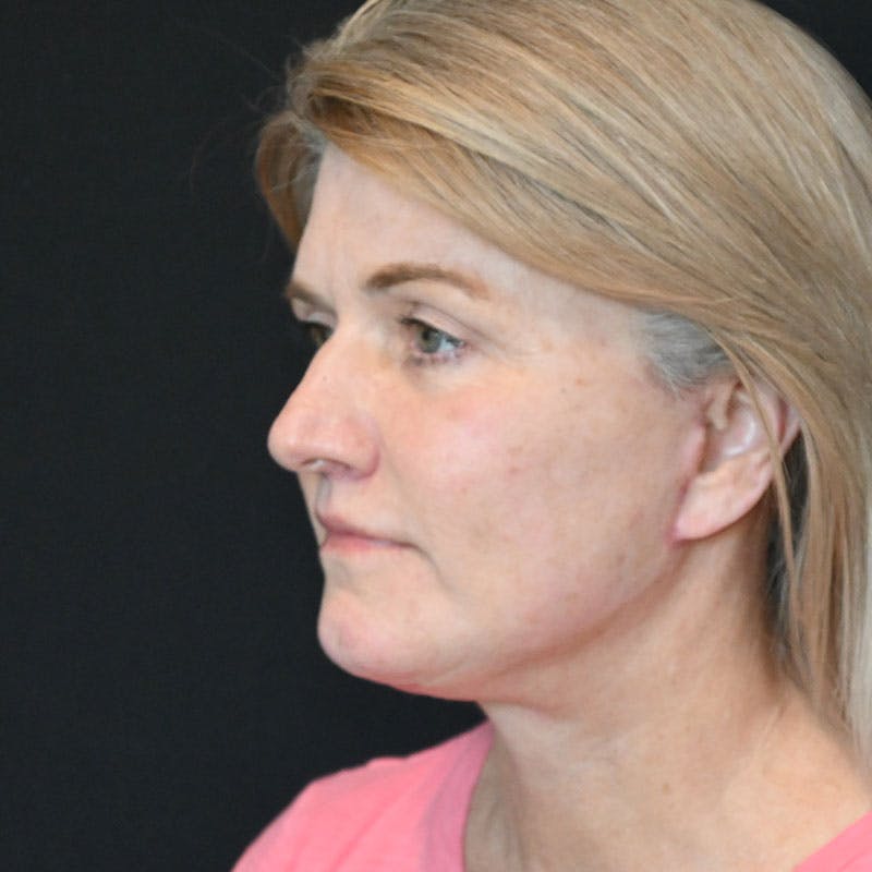 Facelift Before & After Gallery - Patient 188513129 - Image 10