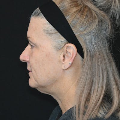 Neck Lift Before & After Gallery - Patient 188513130 - Image 1