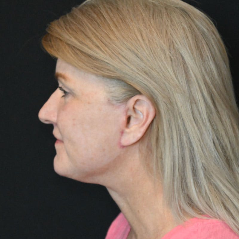 Neck Lift Before & After Gallery - Patient 188513130 - Image 2