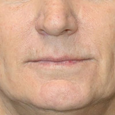 Lip Lift Before & After Gallery - Patient 188513151 - Image 1