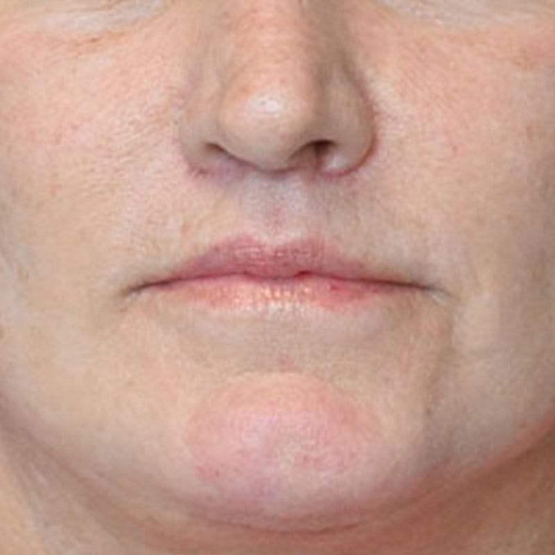 Lip Lift Before & After Gallery - Patient 188513151 - Image 2