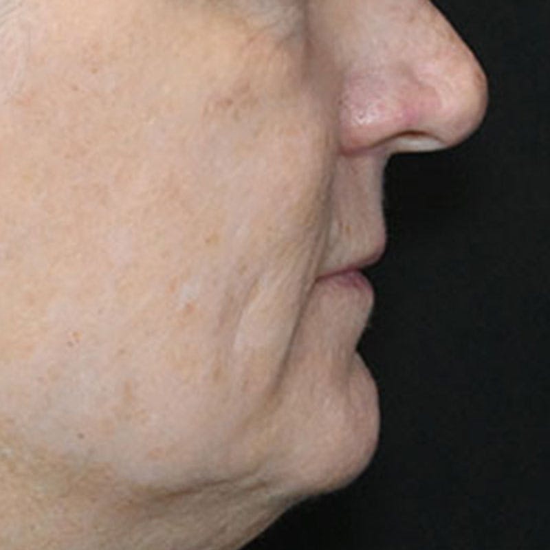 Lip Lift Before & After Gallery - Patient 188513151 - Image 3