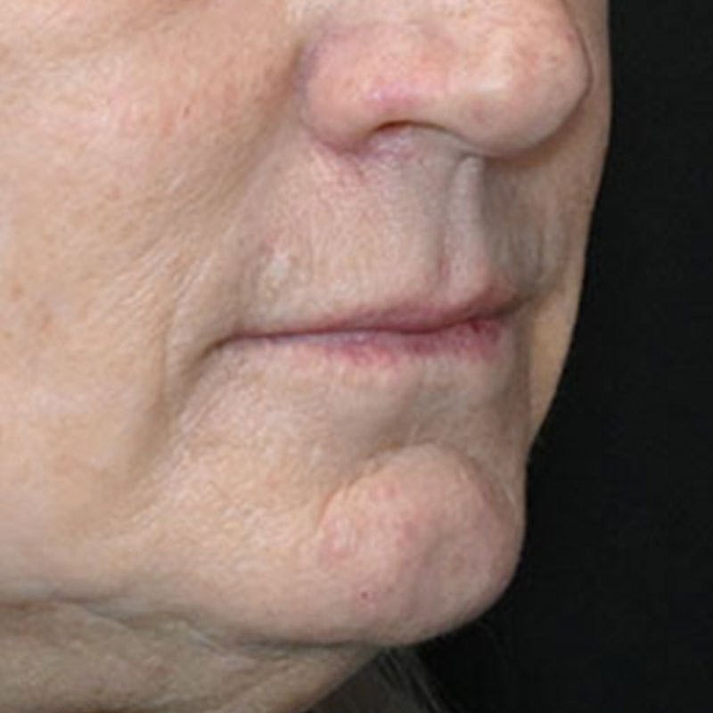 Lip Lift Before & After Gallery - Patient 188513151 - Image 5