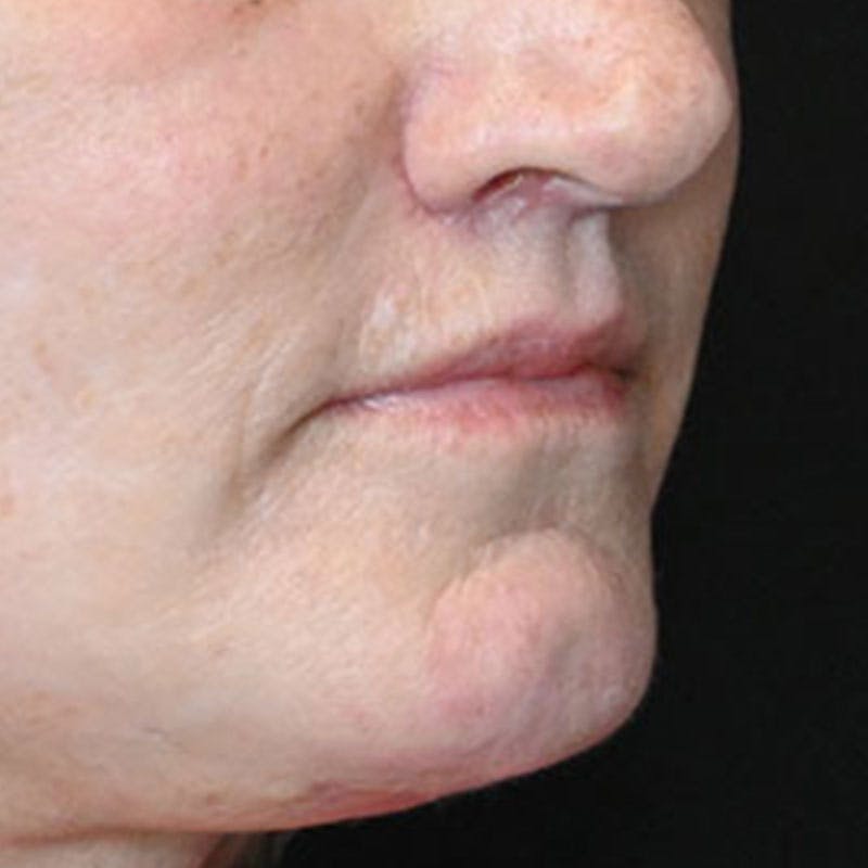 Lip Lift Before & After Gallery - Patient 188513151 - Image 6