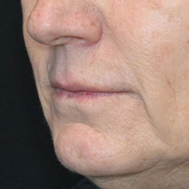 Lip Lift Before & After Gallery - Patient 188513151 - Image 7