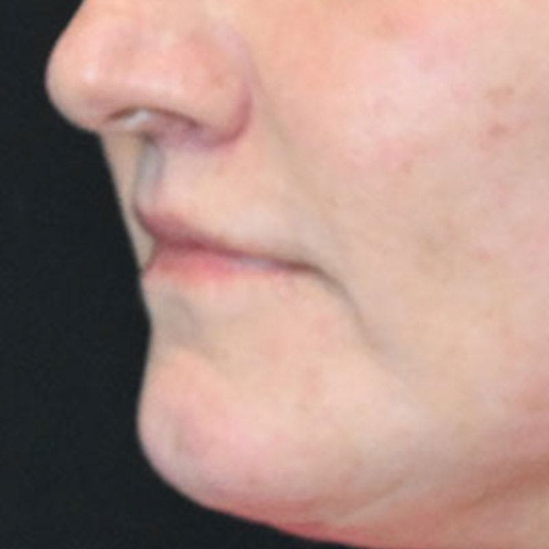 Lip Lift Before & After Gallery - Patient 188513151 - Image 8