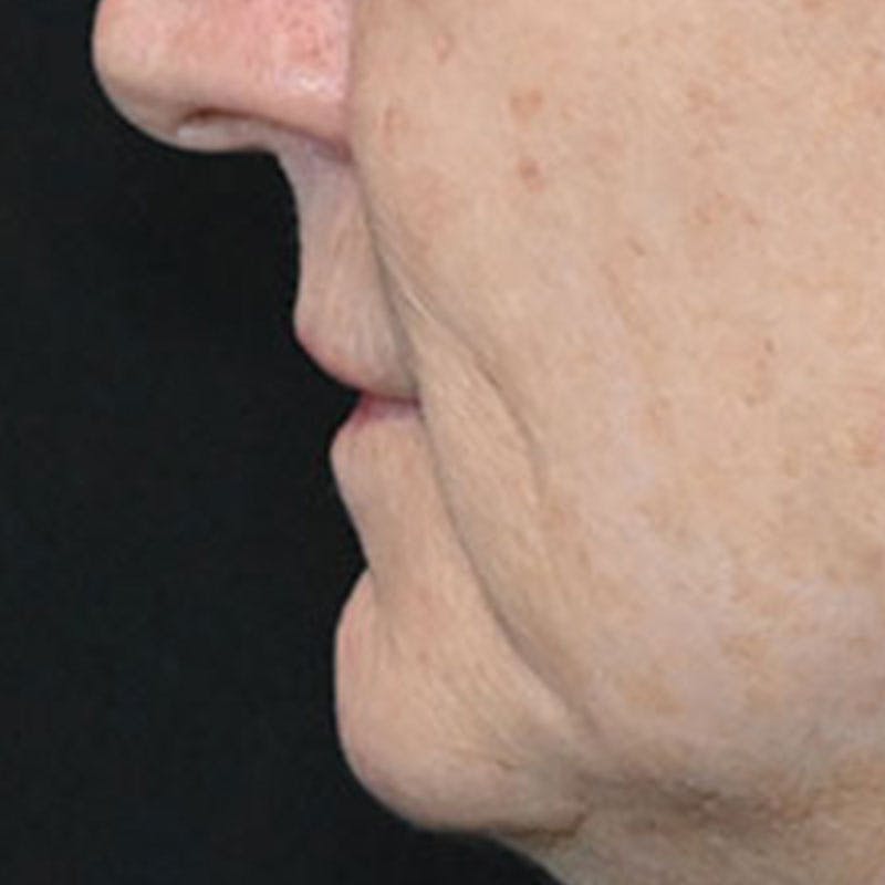 Lip Lift Before & After Gallery - Patient 188513151 - Image 9