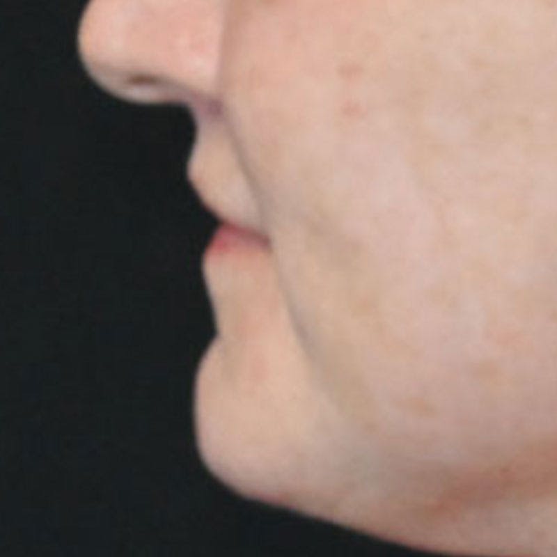 Lip Lift Before & After Gallery - Patient 188513151 - Image 10