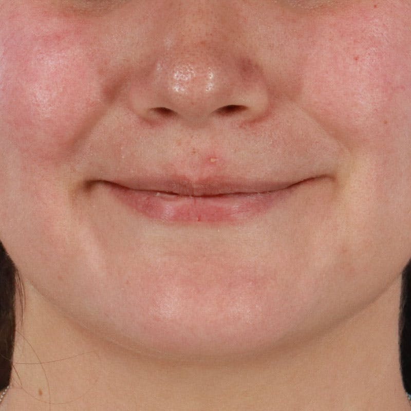 Dermal Fillers Before & After Gallery - Patient 188515263 - Image 1