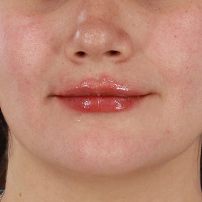 Dermal Fillers Before & After Gallery - Patient 188515263 - Image 2
