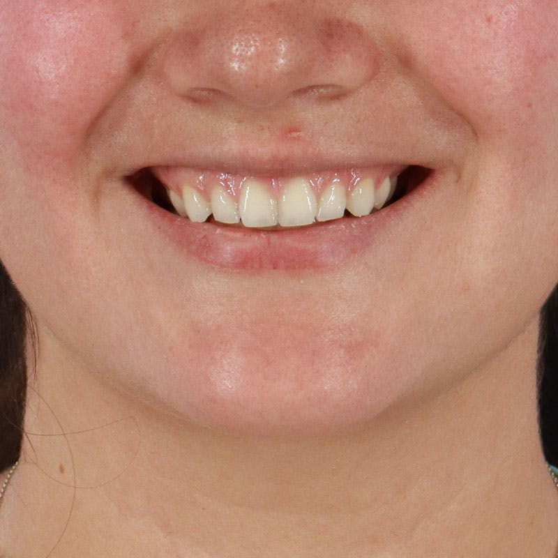 Dermal Fillers Before & After Gallery - Patient 188515263 - Image 3