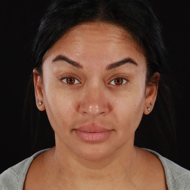 Botox/Dysport/Jeuveau Before & After Gallery - Patient 188515386 - Image 1