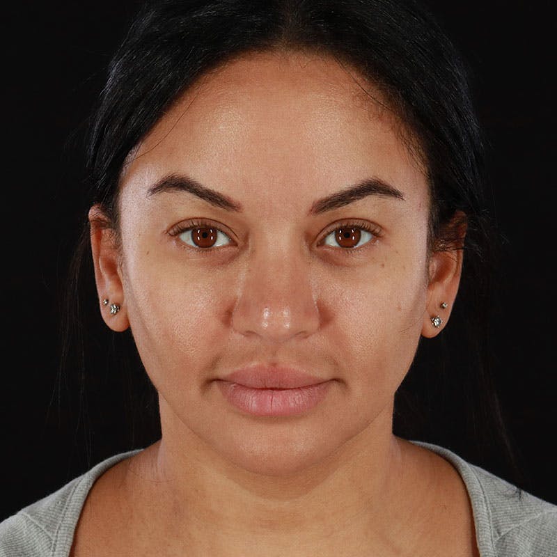 Botox/Dysport/Jeuveau Before & After Gallery - Patient 188515386 - Image 5