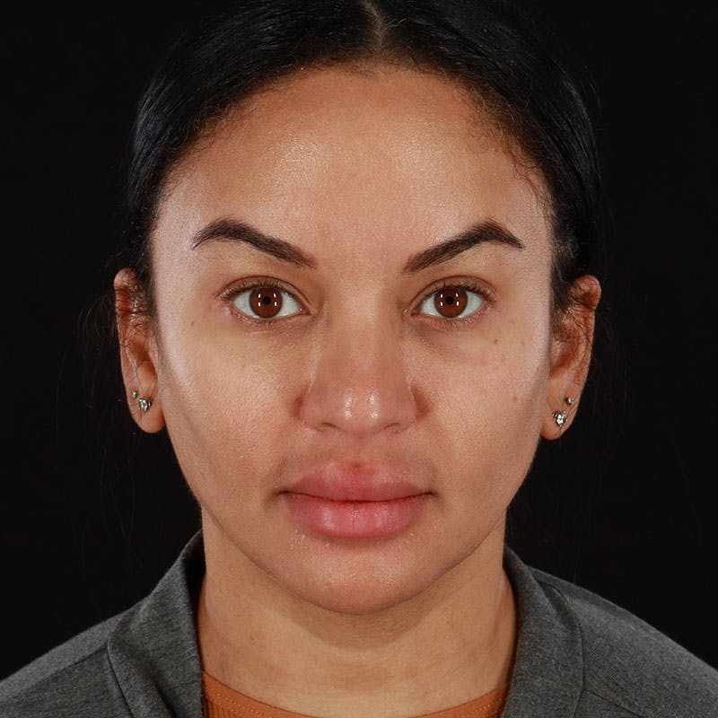 Botox/Dysport/Jeuveau Before & After Gallery - Patient 188515386 - Image 6