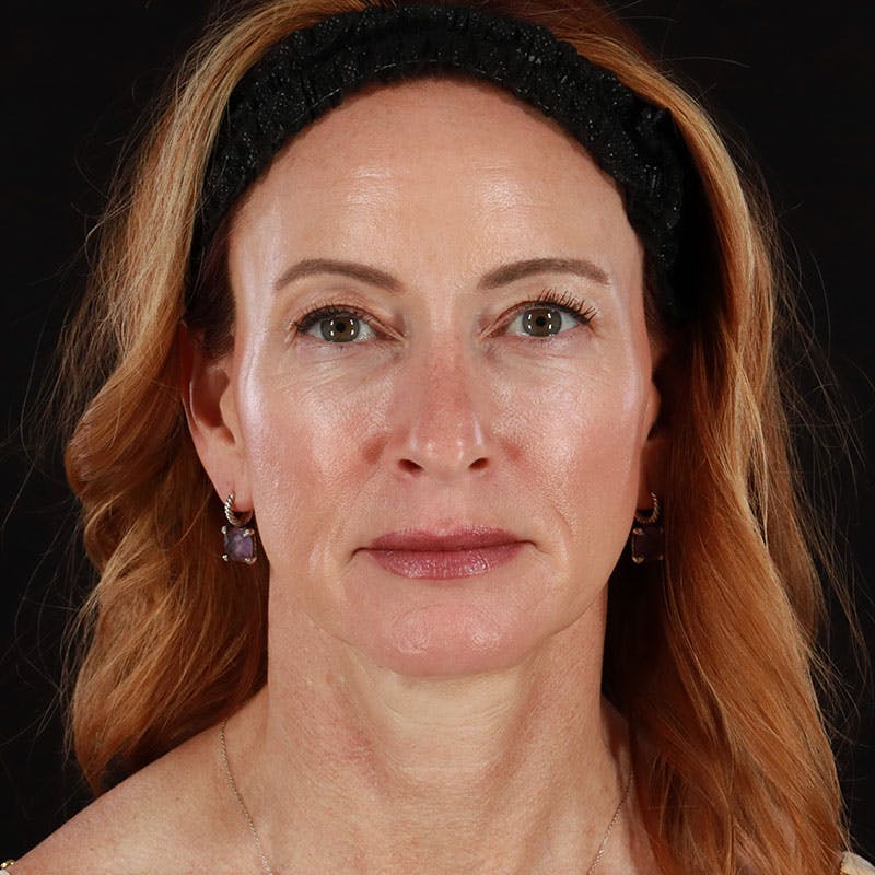 Botox/Dysport/Jeuveau Before & After Gallery - Patient 188515387 - Image 1