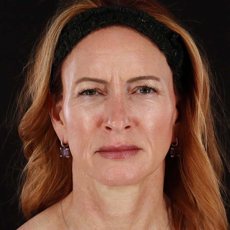 Botox/Dysport/Jeuveau Before & After Gallery - Patient 188515387 - Image 7