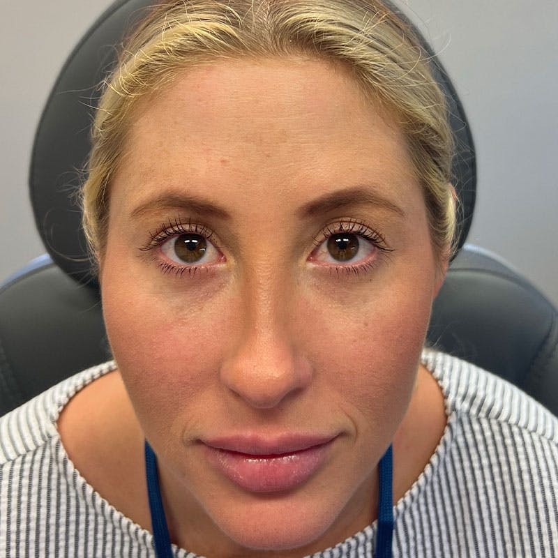 Botox/Dysport/Jeuveau Before & After Gallery - Patient 188515420 - Image 4