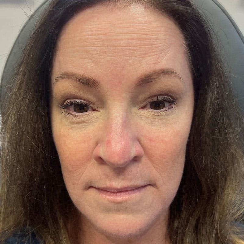 Botox/Dysport/Jeuveau Before & After Gallery - Patient 188515433 - Image 6