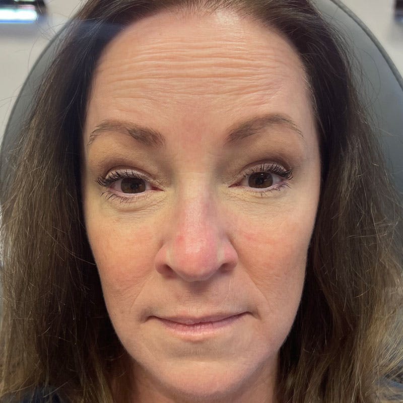 Botox/Dysport/Jeuveau Before & After Gallery - Patient 188515433 - Image 8