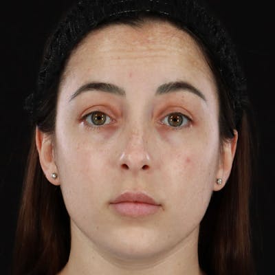 Botox/Dysport/Jeuveau Before & After Gallery - Patient 188515434 - Image 1