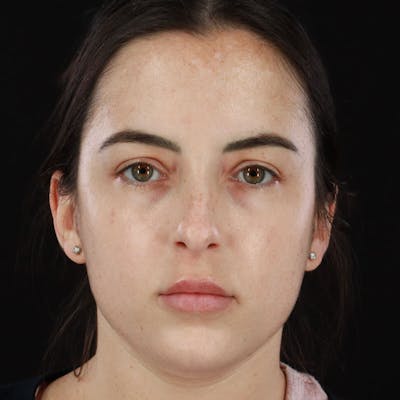 Botox/Dysport/Jeuveau Before & After Gallery - Patient 188515434 - Image 2