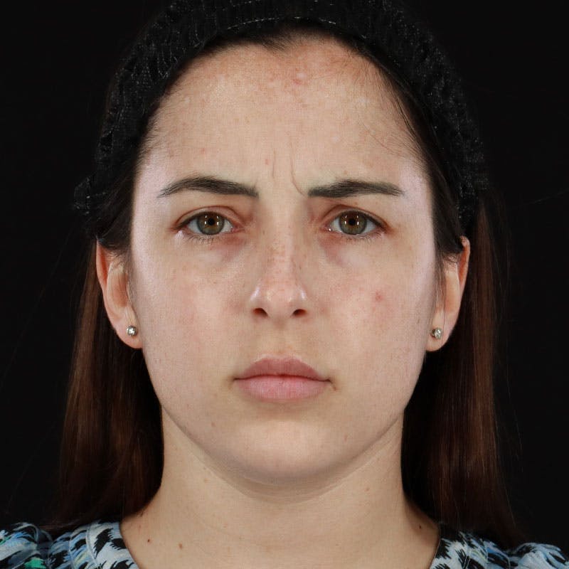 Botox/Dysport/Jeuveau Before & After Gallery - Patient 188515434 - Image 9