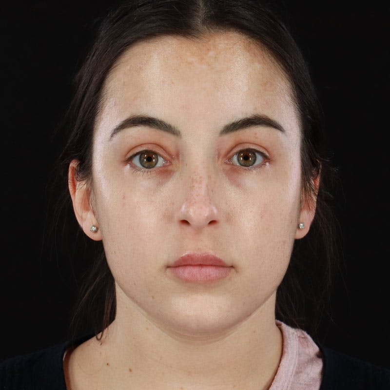 Botox/Dysport/Jeuveau Before & After Gallery - Patient 188515434 - Image 10