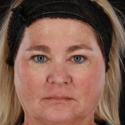 Botox/Dysport/Jeuveau Before & After Gallery - Patient 188515435 - Image 2