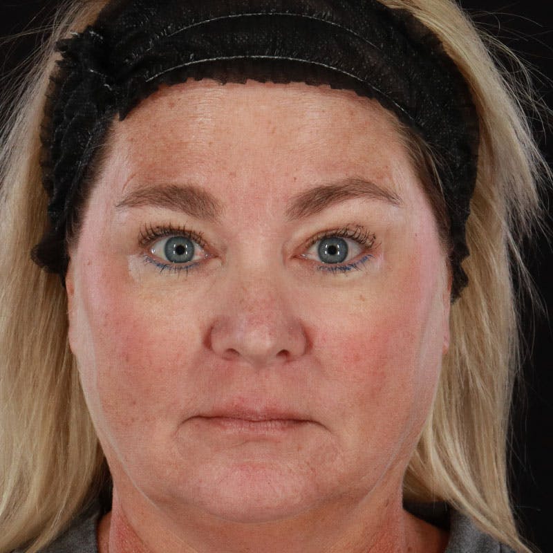 Botox/Dysport/Jeuveau Before & After Gallery - Patient 188515435 - Image 4