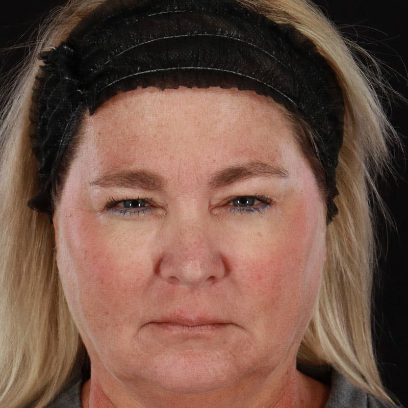 Botox/Dysport/Jeuveau Before & After Gallery - Patient 188515435 - Image 6