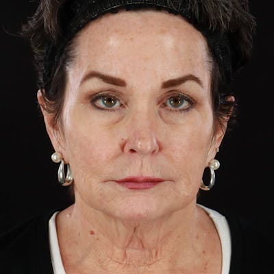 Botox/Dysport/Jeuveau Before & After Gallery - Patient 188515445 - Image 1