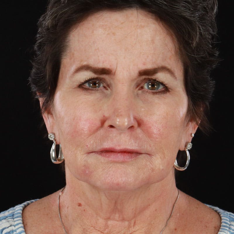 Botox/Dysport/Jeuveau Before & After Gallery - Patient 188515445 - Image 2