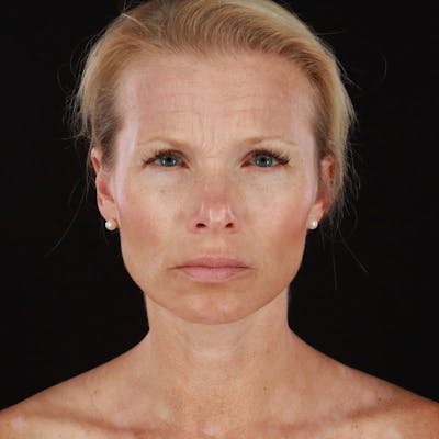 Botox/Dysport/Jeuveau Before & After Gallery - Patient 188515446 - Image 1