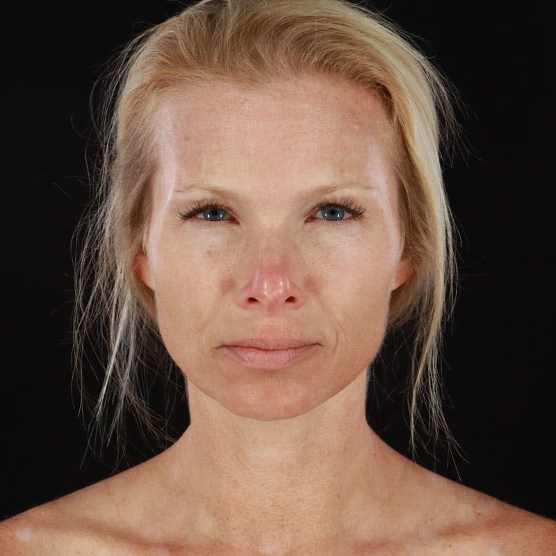 Botox/Dysport/Jeuveau Before & After Gallery - Patient 188515446 - Image 2